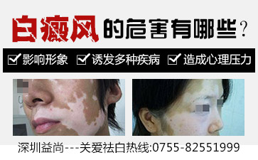 深圳宝安区白斑病治疗医院女性白斑患者应该如何护理
